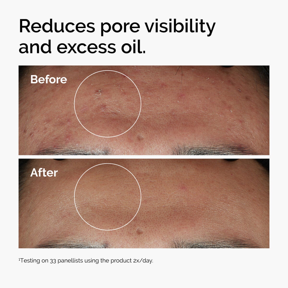niacinamide-10-zinc-1-e1 ord-niacinamide-zinc-blemish-serum-before-after-pores.jpg