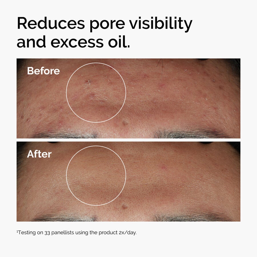 niacinamide-10-zinc-1-e1 ord-niacinamide-zinc-blemish-serum-before-after-pores.jpg